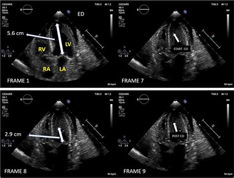 lv intracavitary gradient|intracavitary gradient tte.